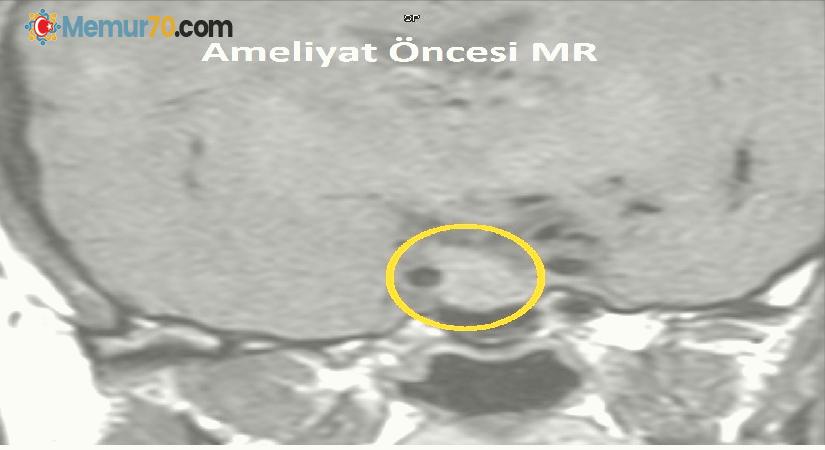 Hipofiz tümörü olan kadın başarılı bir ameliyatla tedavi edildi