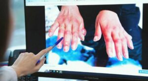 Kış geldi, risk arttı soğuk ısırığına dikkat